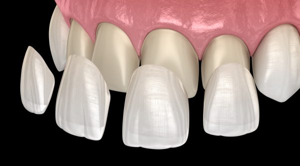 Mặt dán sứ Veneer 1