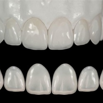 Răng Sứ Emax