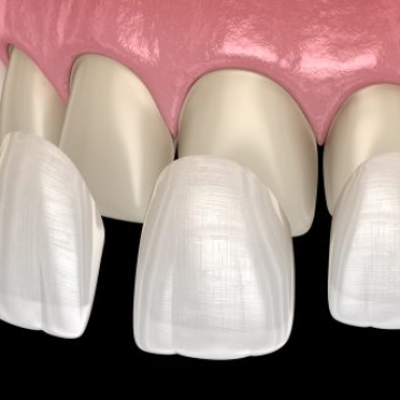 Mặt dán sứ Veneer 1