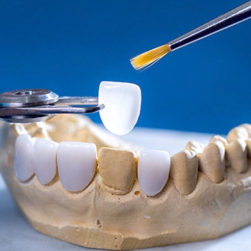 Mặt dán sứ Veneer 3