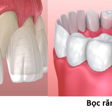 Mặt dán sứ Veneer 4
