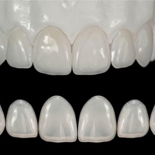 Răng Sứ Emax