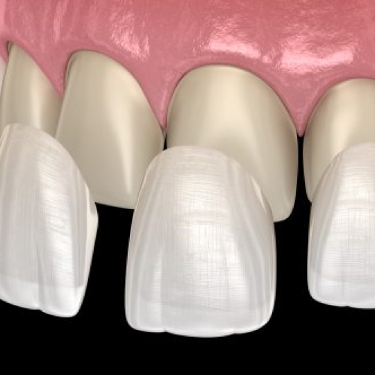 Mặt dán sứ Veneer 1